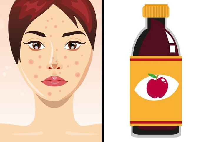To remove acne: use apple cider vinegar