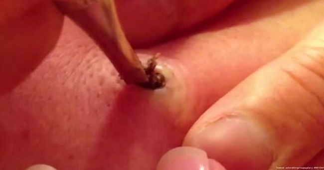 This girl decided to remove an old zit from her aunt’s skin; she never imagined what she found in the hole