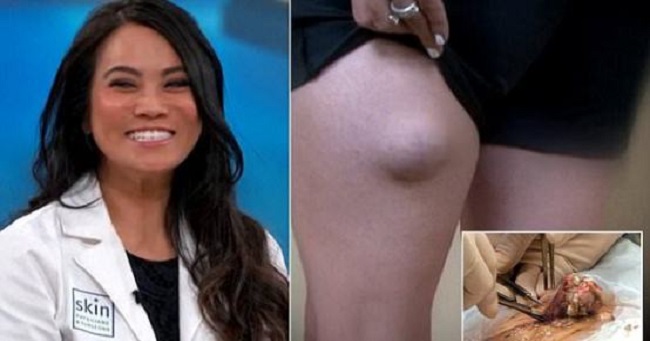 This pimple popping video will simply gross you out